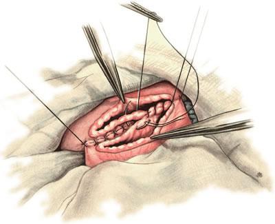 Gastroenterostomia antecolica anterior (Наложение непрерывного кетгутового шва на задние губы анастомоза)