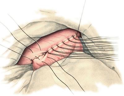 Gastroenterostomia antecolica anterior (Наложение серозно-мышечных швов на переднюю стенку анастомоза)