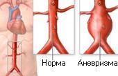 Выживаемость при двух типах репарации аневризмы брюшной аорты одинакова