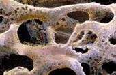 Быстрая потеря костной массы, связанная с переломами ребер, лечится стероидами