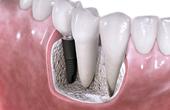 Ученые выращивают зубы из клеток десны