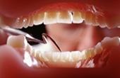 Фтористые соединения борются с разрушениями зубов