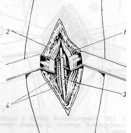 доступ к передней большеберцовой артерии: 1 &mdash; m. tibialis anterior, 2 &mdash; mm. extensor hallucis longus et digitorum longus, 3 &mdash; a. tibialis anterior. 4 &mdash; vv- tibialis anterior