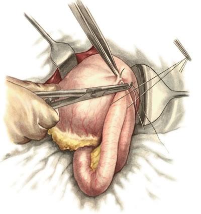 Gastroenterostomia antecolica anterior (операция Вельфлера)