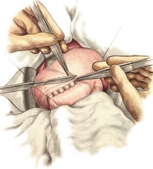Gastroenterostomia antecolica anterior (Рассечение серозной и мышечной оболочек желудка)