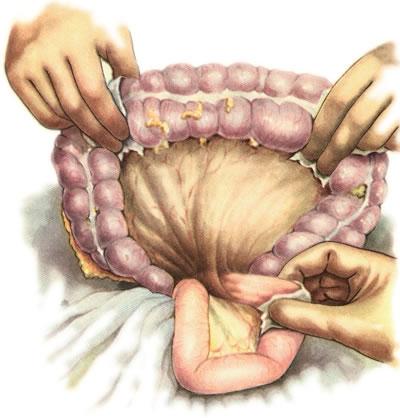 Gastroenterostomia retrocolica posterior (операция Гаккера в модификации Петерсена)