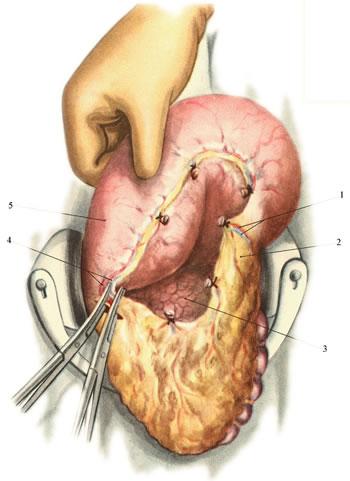 Мобилизация желудка (Пересечение a. et v. gastro-epiploica dextra)