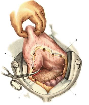 Пересечение ветвей a. et v. gastroduodenalis Пересечение ветвей a. et v. gastroduodenalis