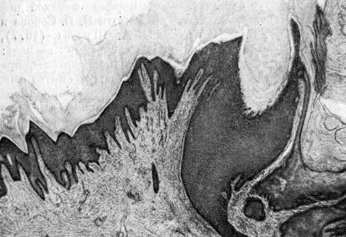 Акрокератоз верруциформный Гопфа (acrodermatitis verruciformis Hopf)