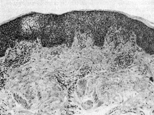 Дерматит (dermatitis)