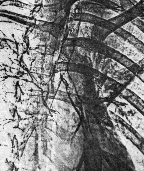 Контурная электробронхограмма Контурная электробронхограмма