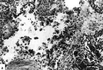 Гистологические препараты больного В. (48 лет, анафилактический шок) (а) Гистологические препараты больного В. (48 лет, анафилактический шок) (а)